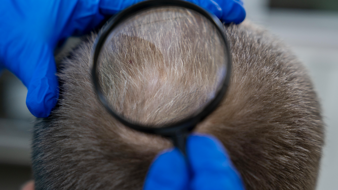 Vacuna contra la alopecia: qué es y cuándo estaría disponible