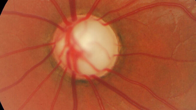 Nueva prueba genética para detectar el glaucoma con 15 veces más de efectividad