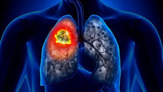 Descubren como diagnosticar el cáncer de pulmón un año antes